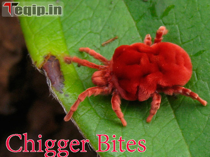 Chigger Bites